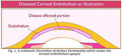 corneaendodiseased01